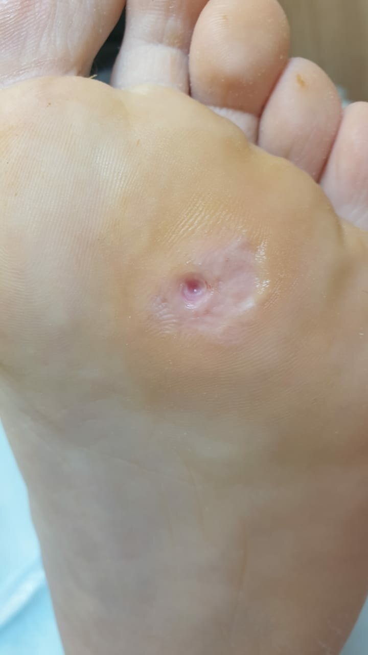 Стержневая мозоль, обработка