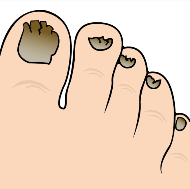 Грибок ногтей, обработка