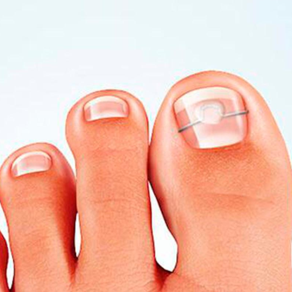 Коррекционная система Скоба, Unibrace, 3ТО