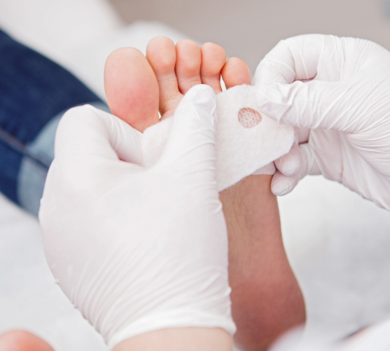 Мозоль у ребёнка