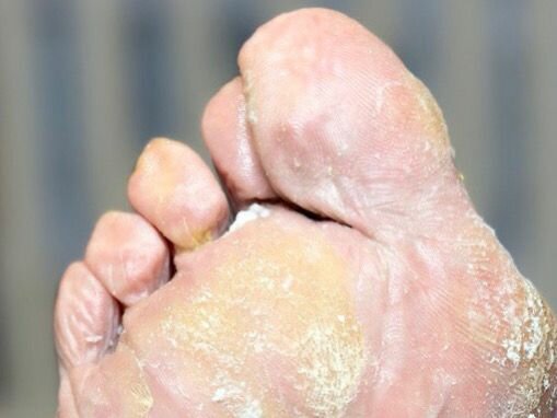 Грибок на пальцах, обработка