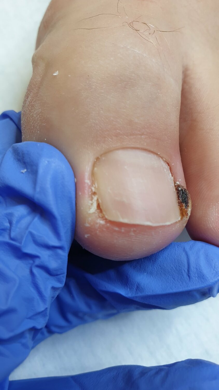 Коррекция вросшего ногтя