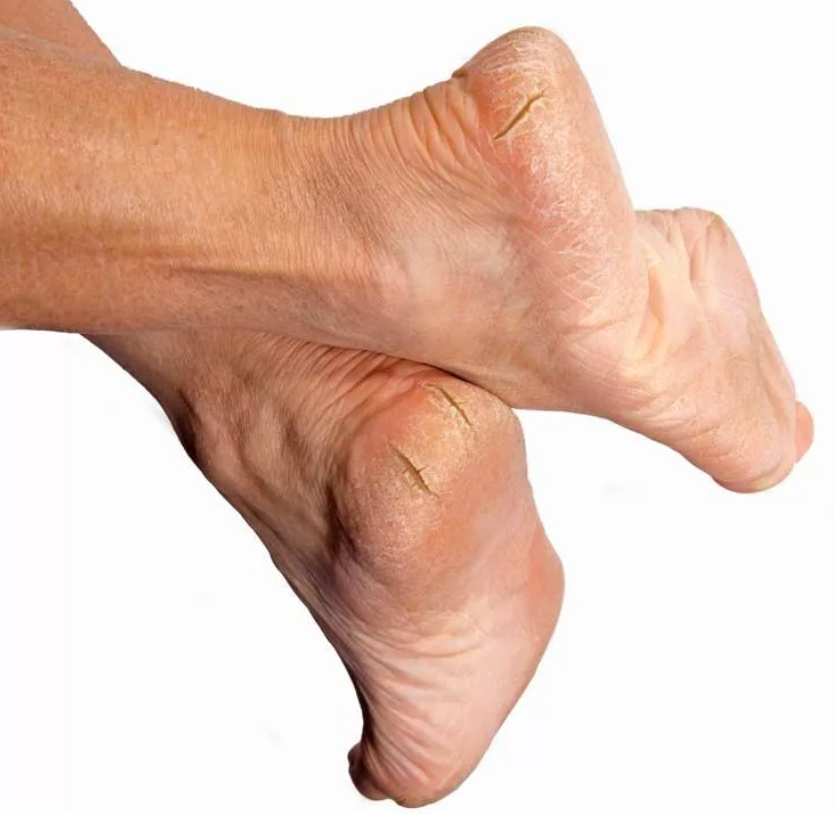 Трещины на пятках