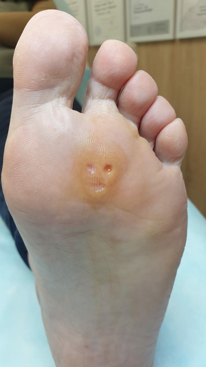 Стержневая мозоль, обработка