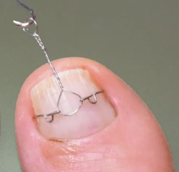 Коррекционная система Скоба, Unibrace, 3ТО