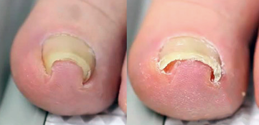 Скрученные ногти