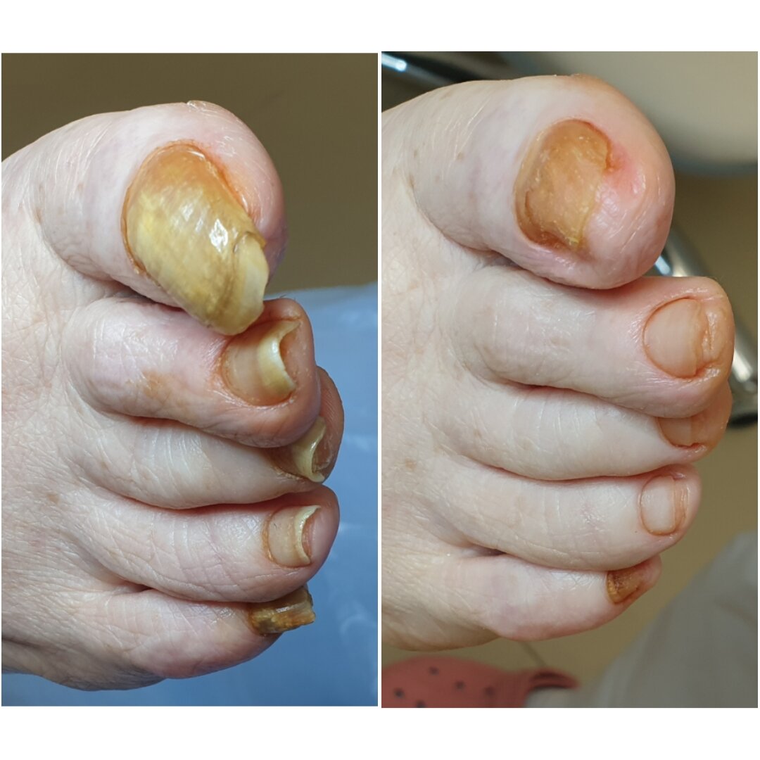 Онихогрифоз ногтей, обработка.