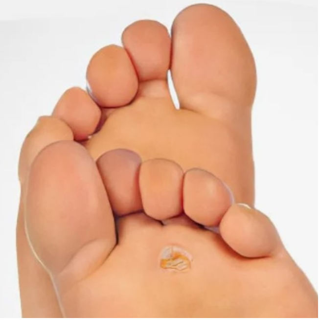 Шипица, шипига, шипичка удаление