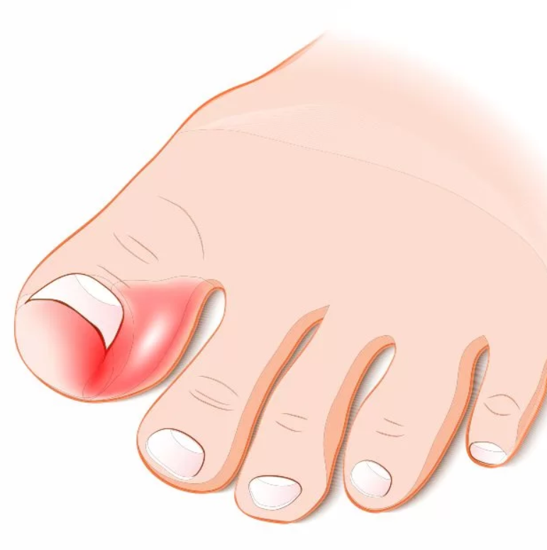 Вросший ноготь на ноге, удаление угла