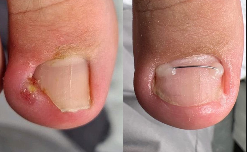 Коррекционная система Скоба, Unibrace, 3ТО