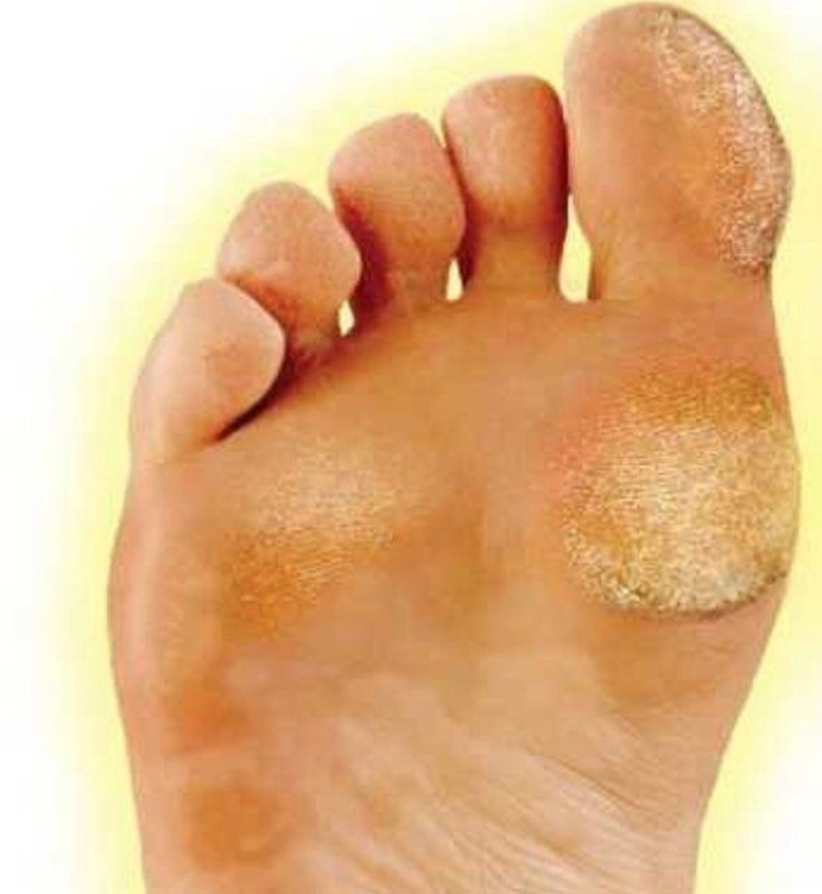 Натоптыши на пятках и стопе, удаление, обработка