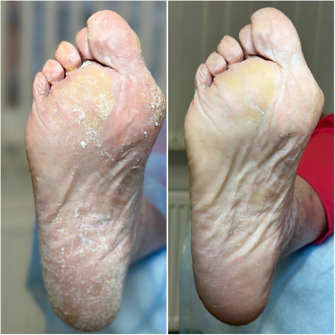 Грибок стопы, обработка