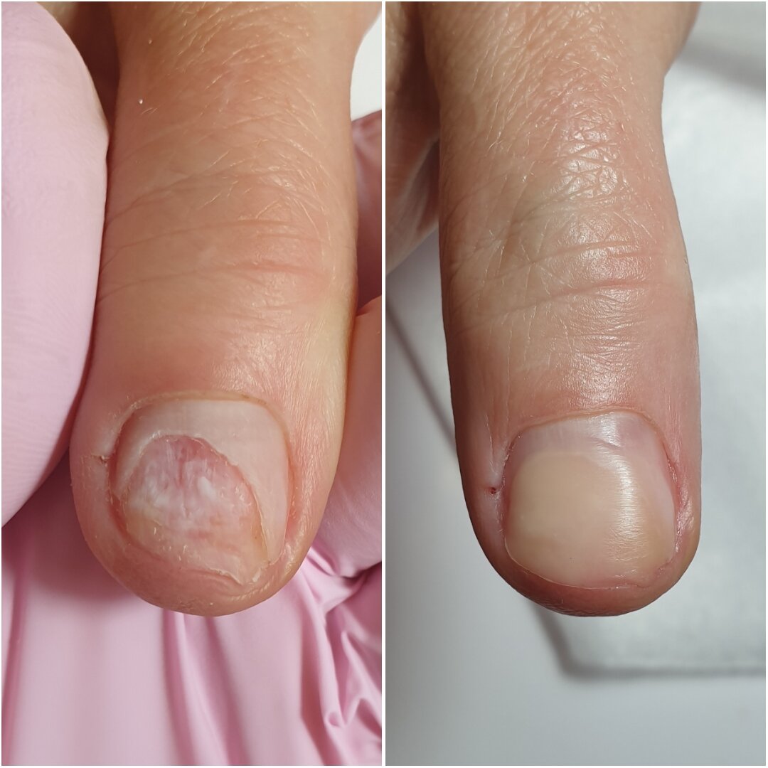 Протезирование, восстановление ногтей