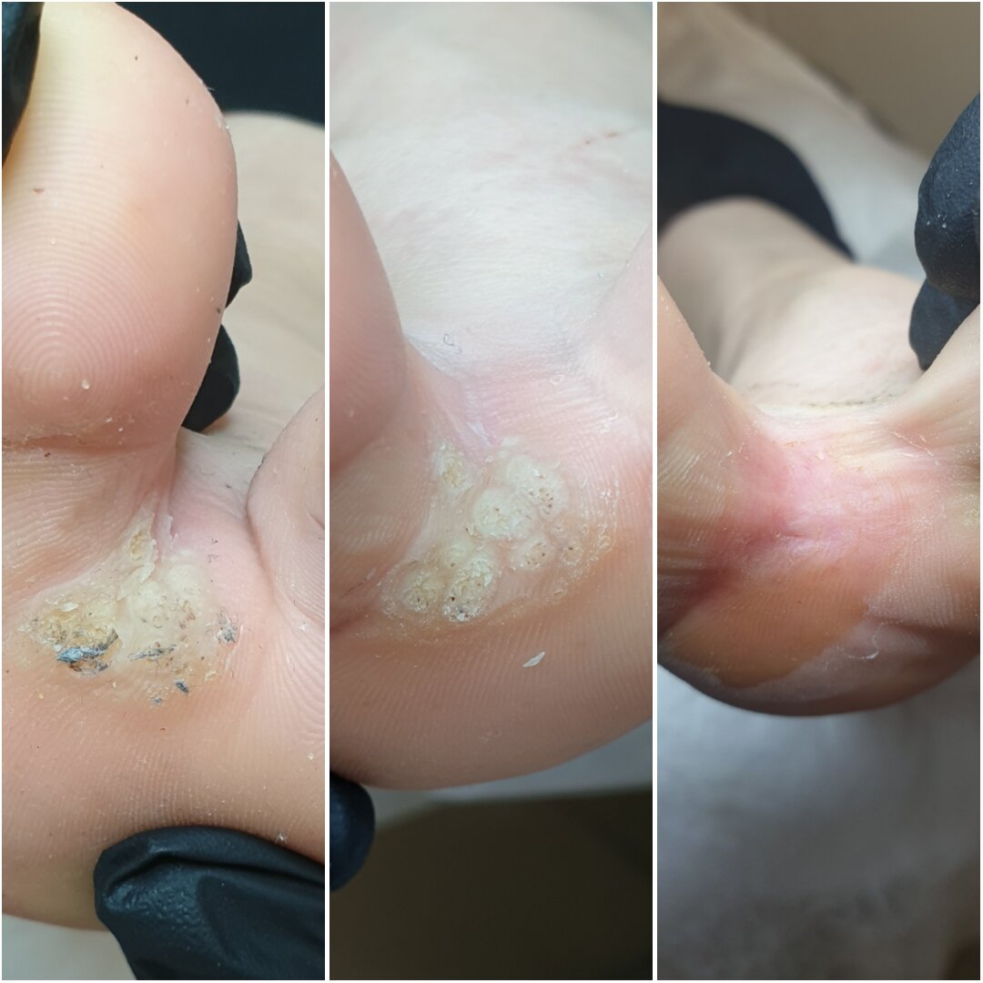 Бородавка между пальцами, обработка