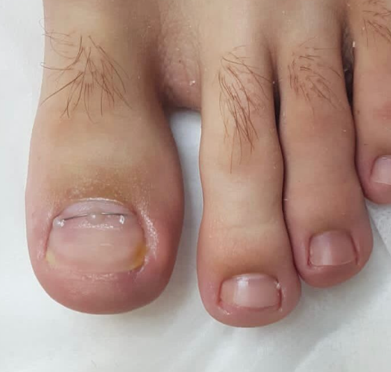 Коррекционная система Скоба, Unibrace, 3ТО