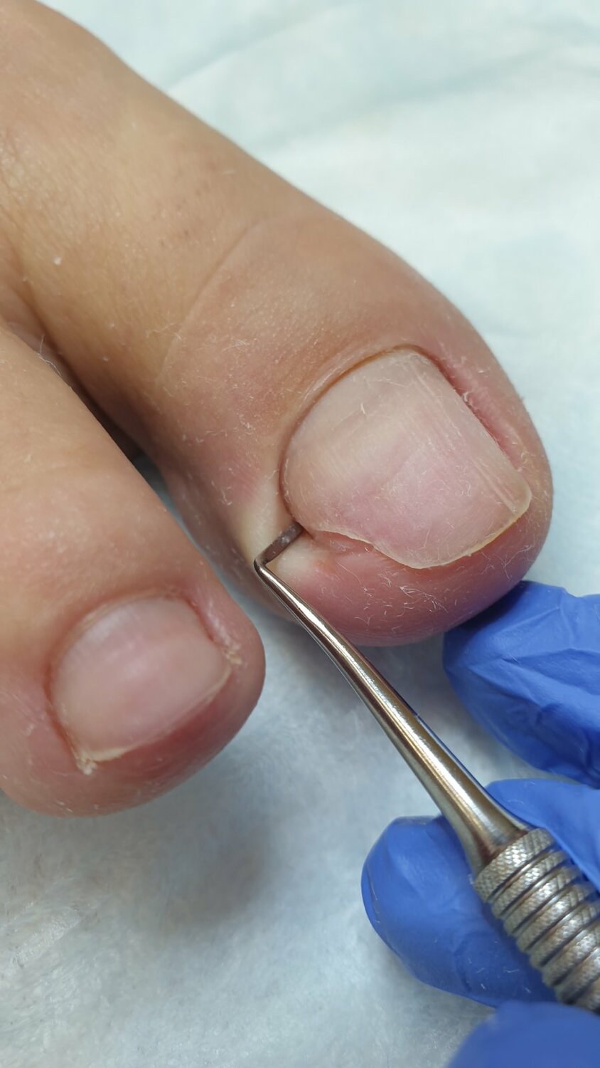 Коррекция вросшего ногтя