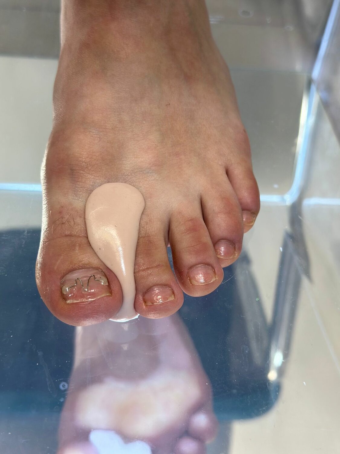 Ортоз на пальцы