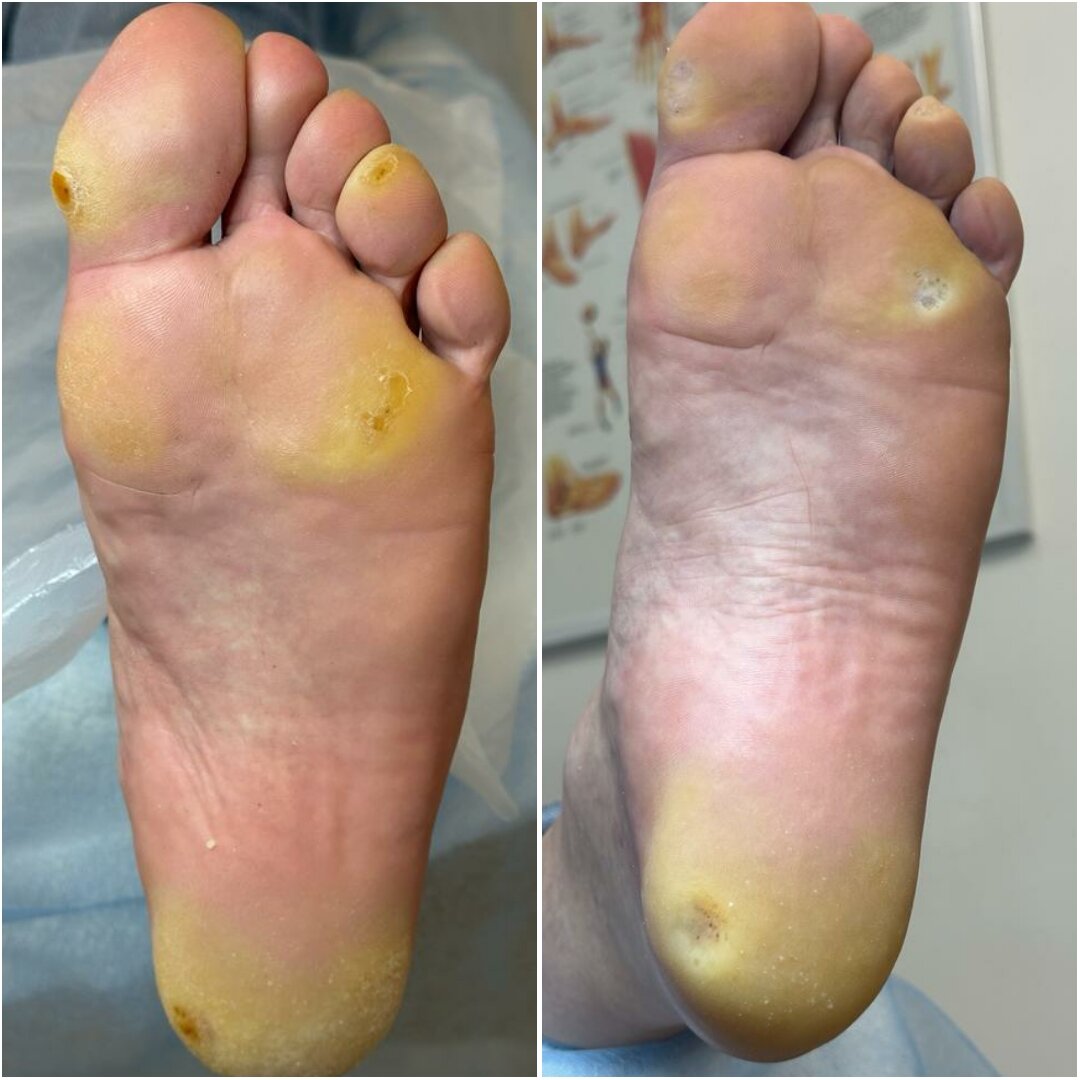 Омозолелость стопы, обработка