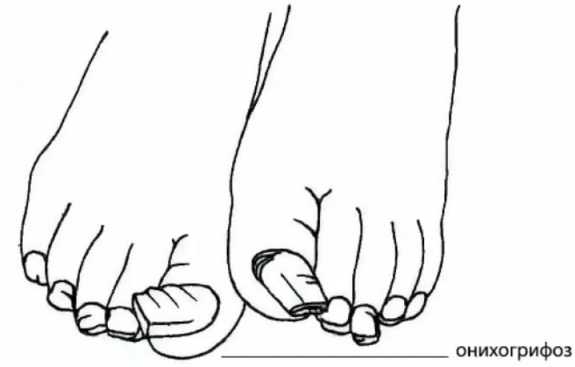 Онихогрифоз ногтей, обработка.