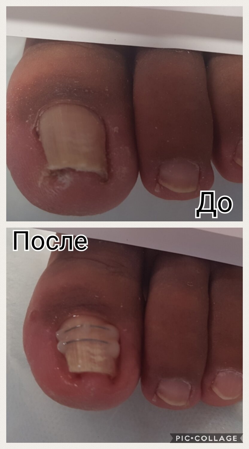 Коррекция вросшего ногтя