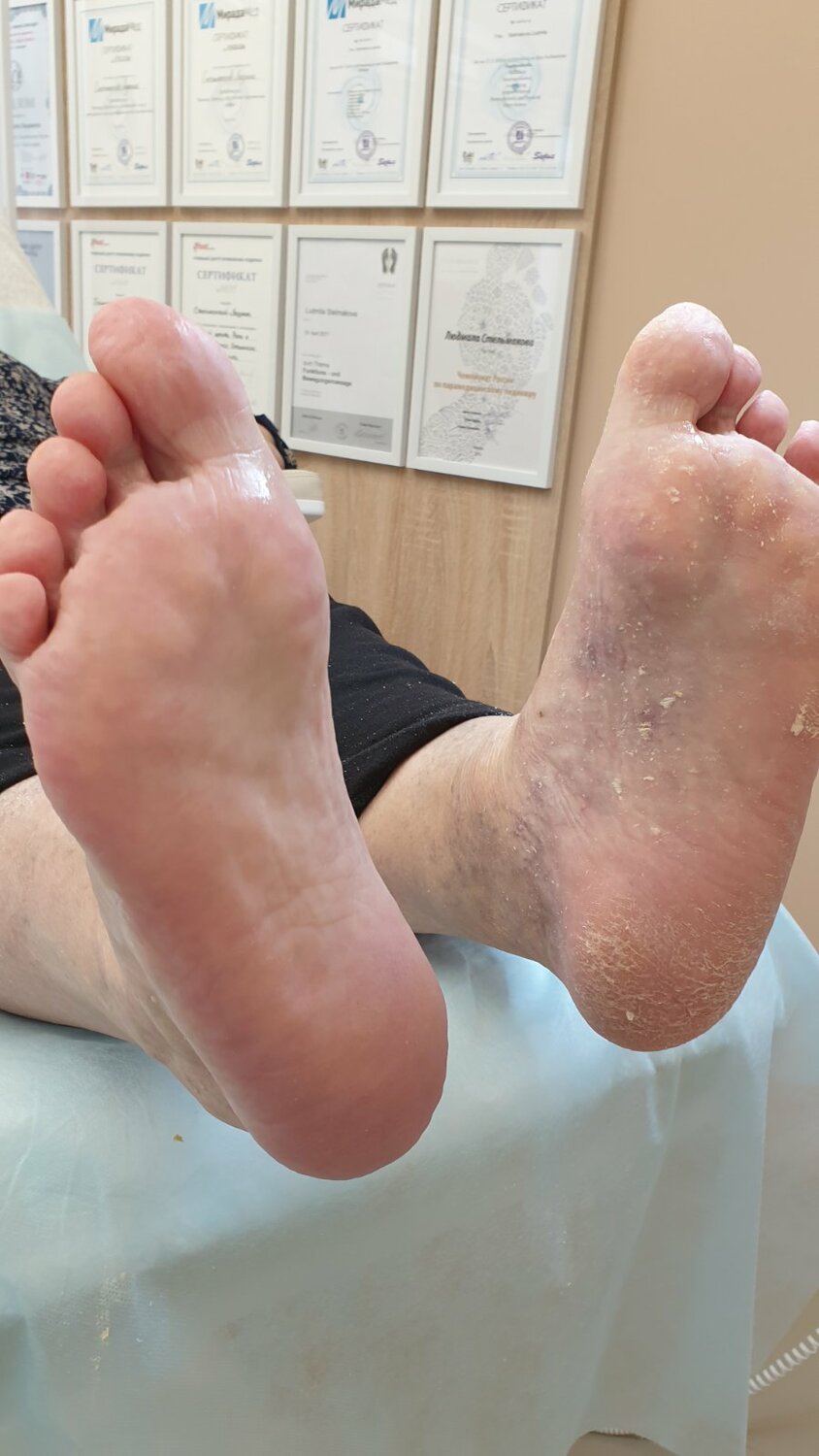 Обработка мозолей