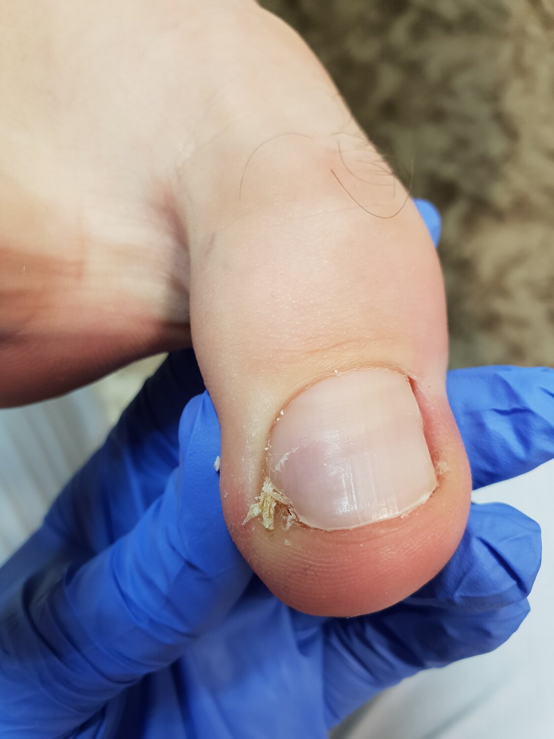 Решение проблемы вросшего ногтя.