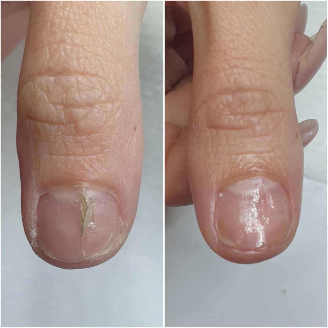 Протезирование, восстановление ногтей