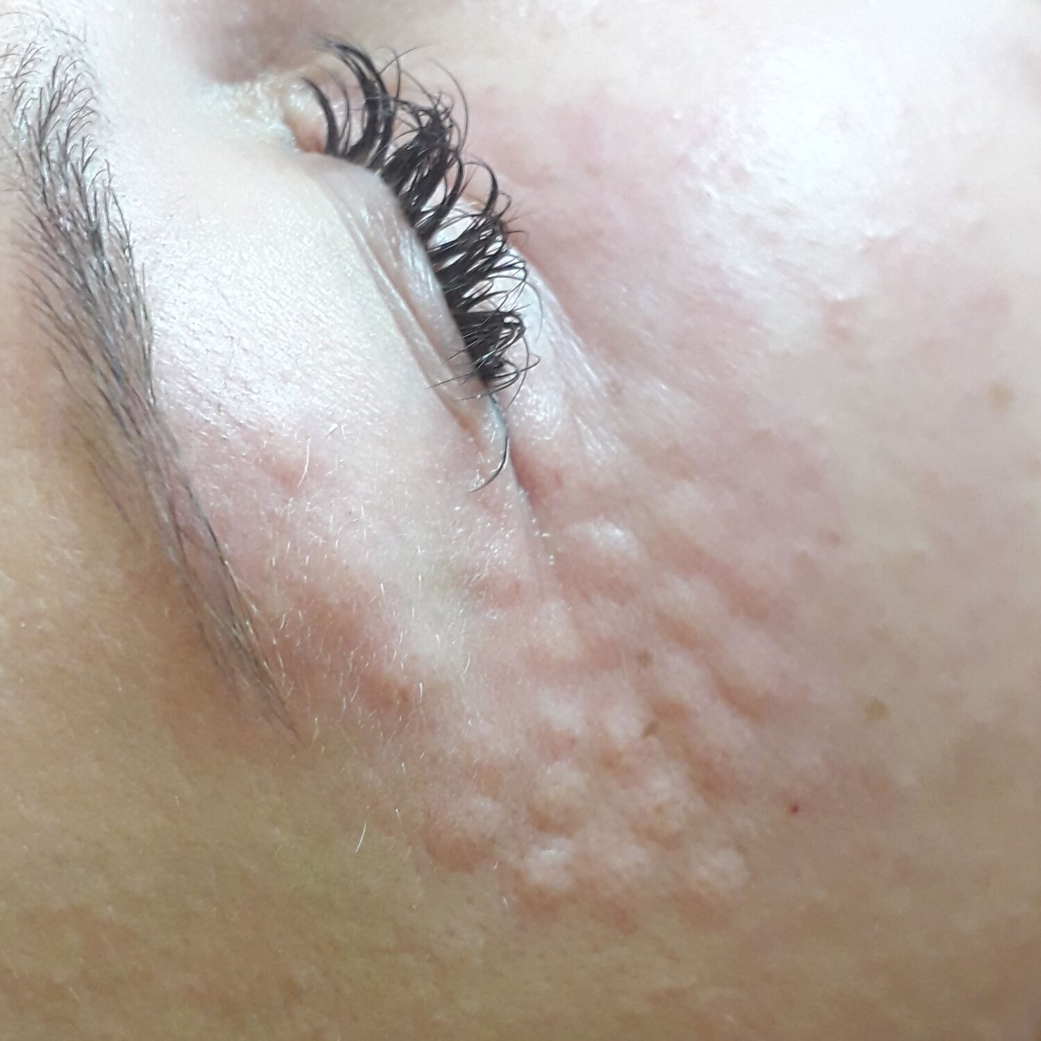 Мезотерапия лица