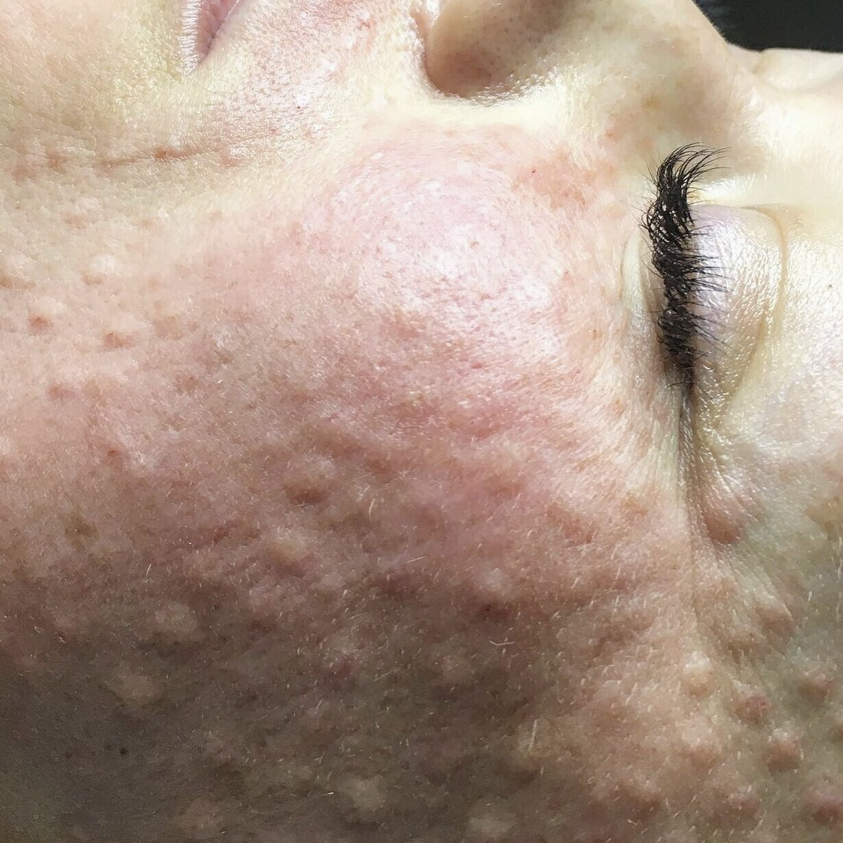 Биоревитализация