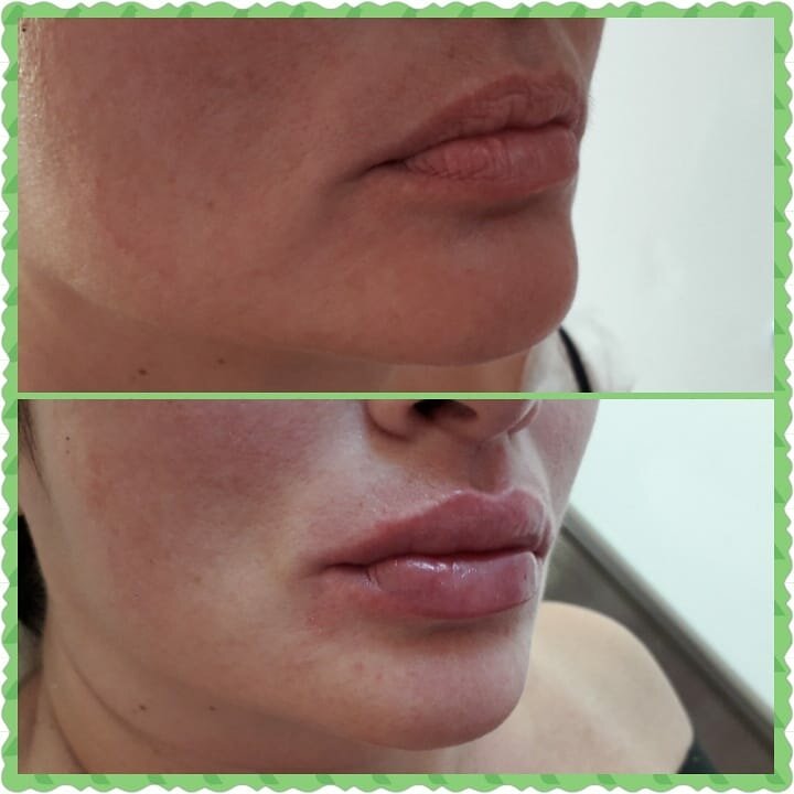 Увеличение губ
