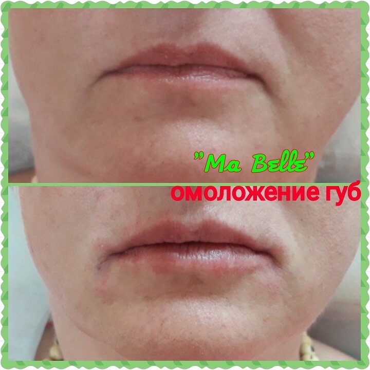 Увеличение губ