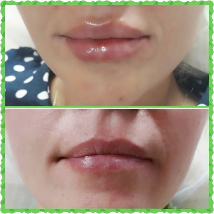 Увеличение губ