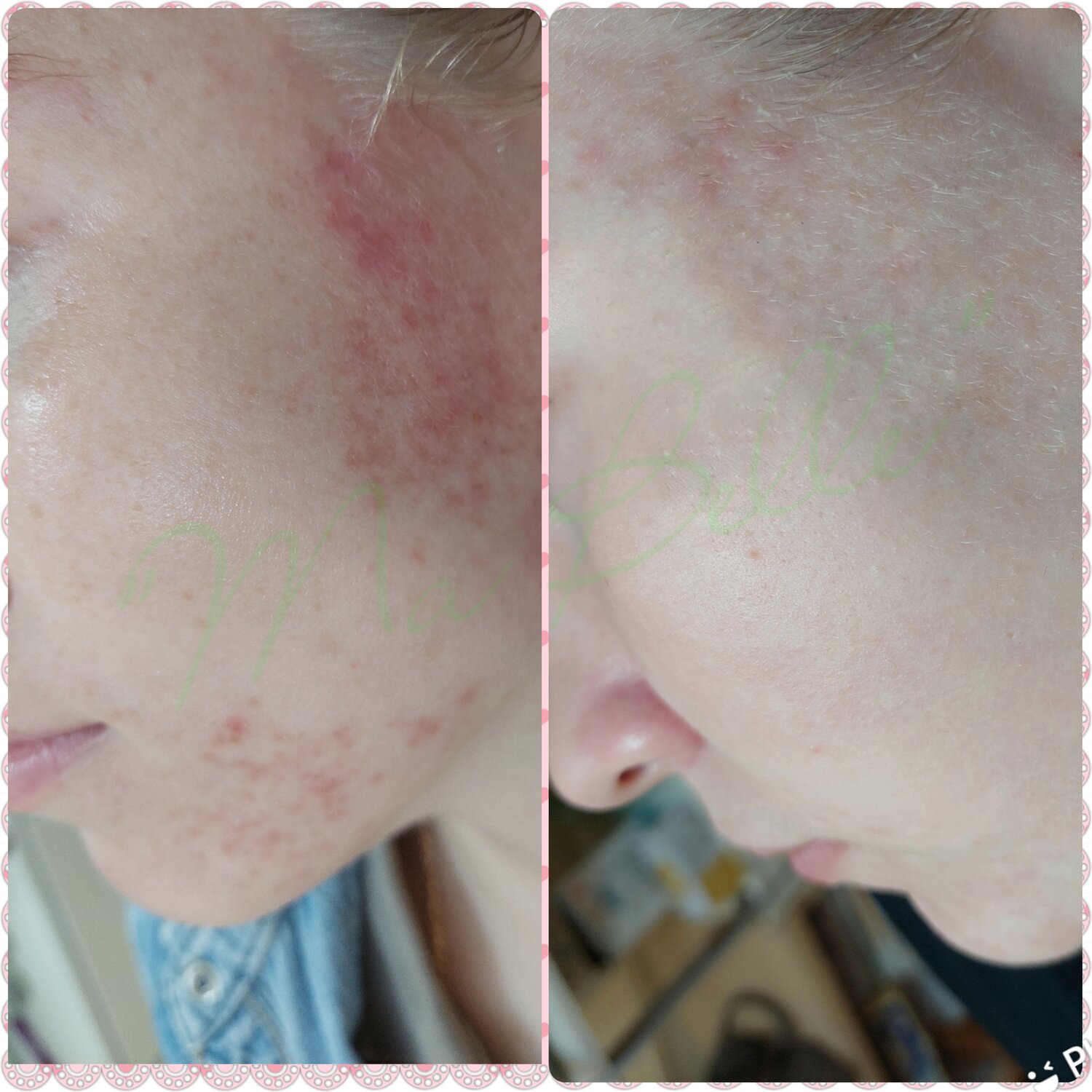 Лечение угревой сыпи