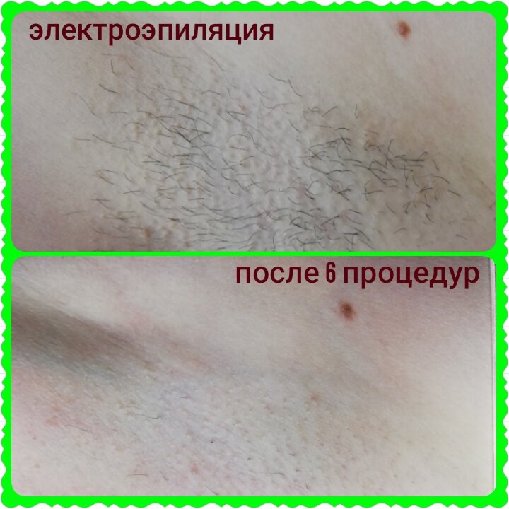 Электроэпиляция: подмышки