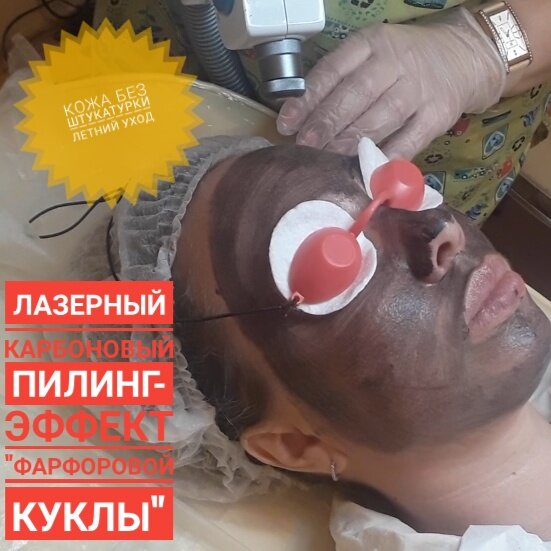 Карбоновый пилинг