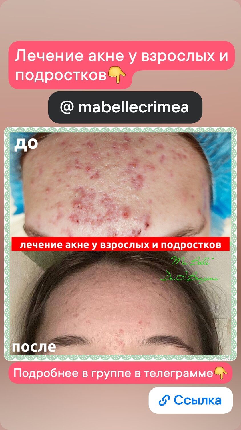 Лечение угревой сыпи