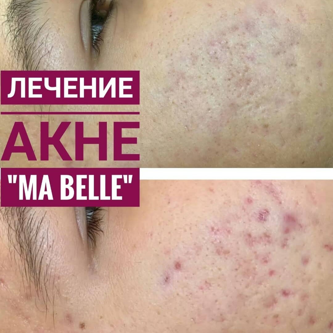 Лечение угревой сыпи