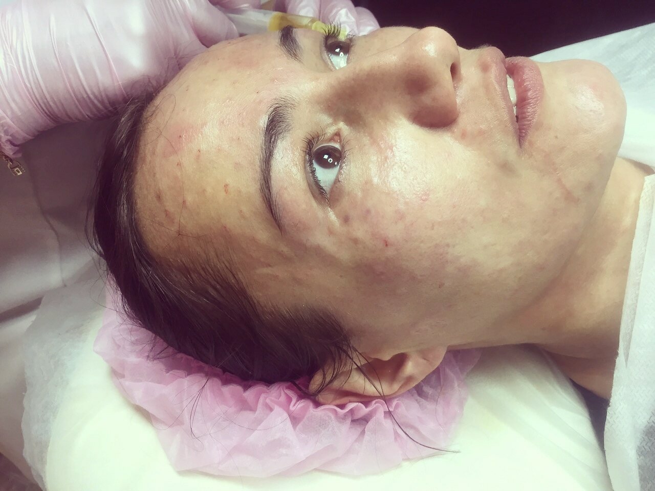 Плазмолифтинг