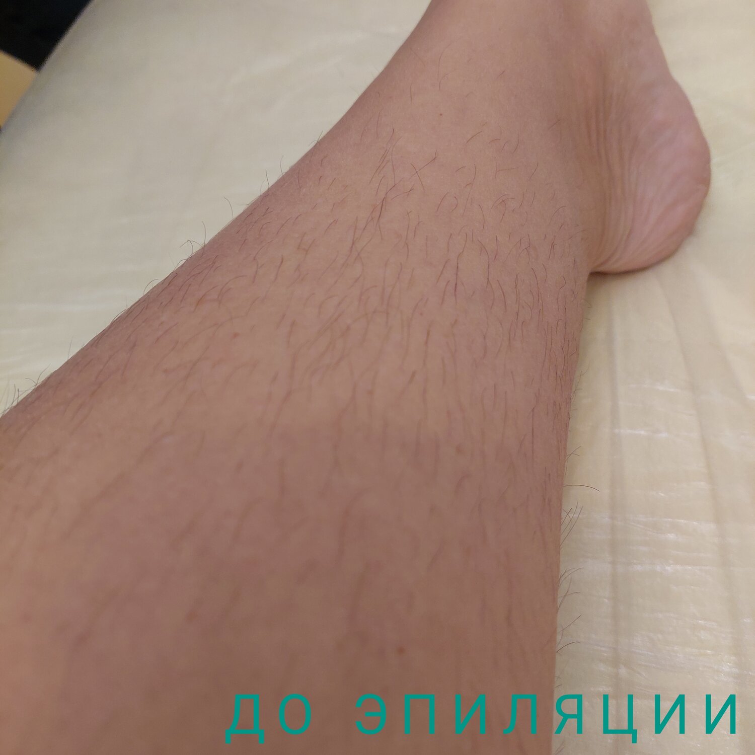 Лазерная эпиляция ног