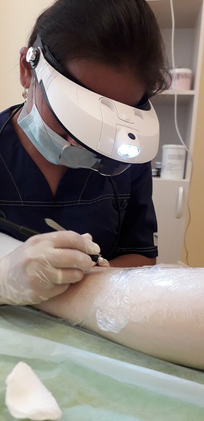 Электроэпиляция: подмышки