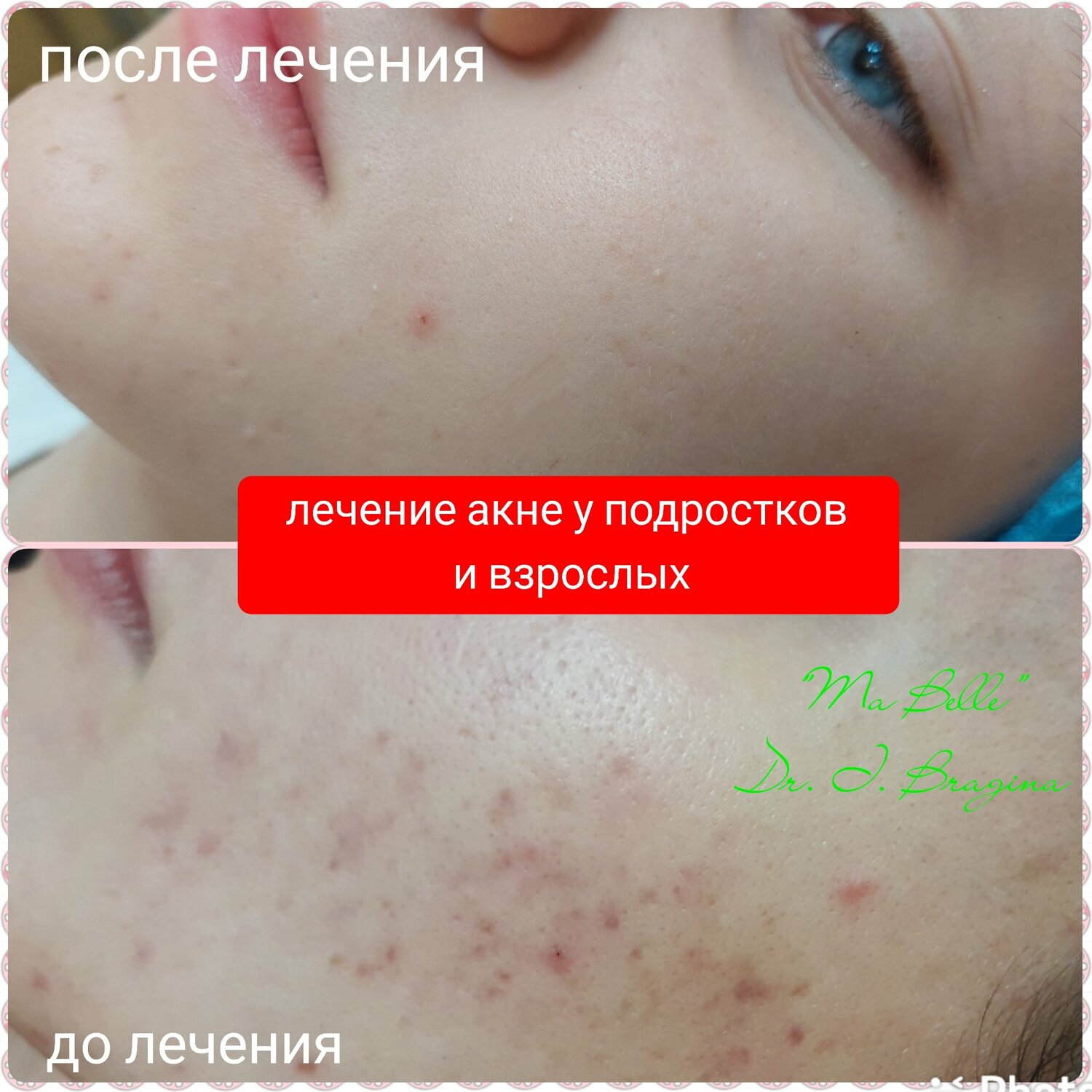 Лечение угревой сыпи