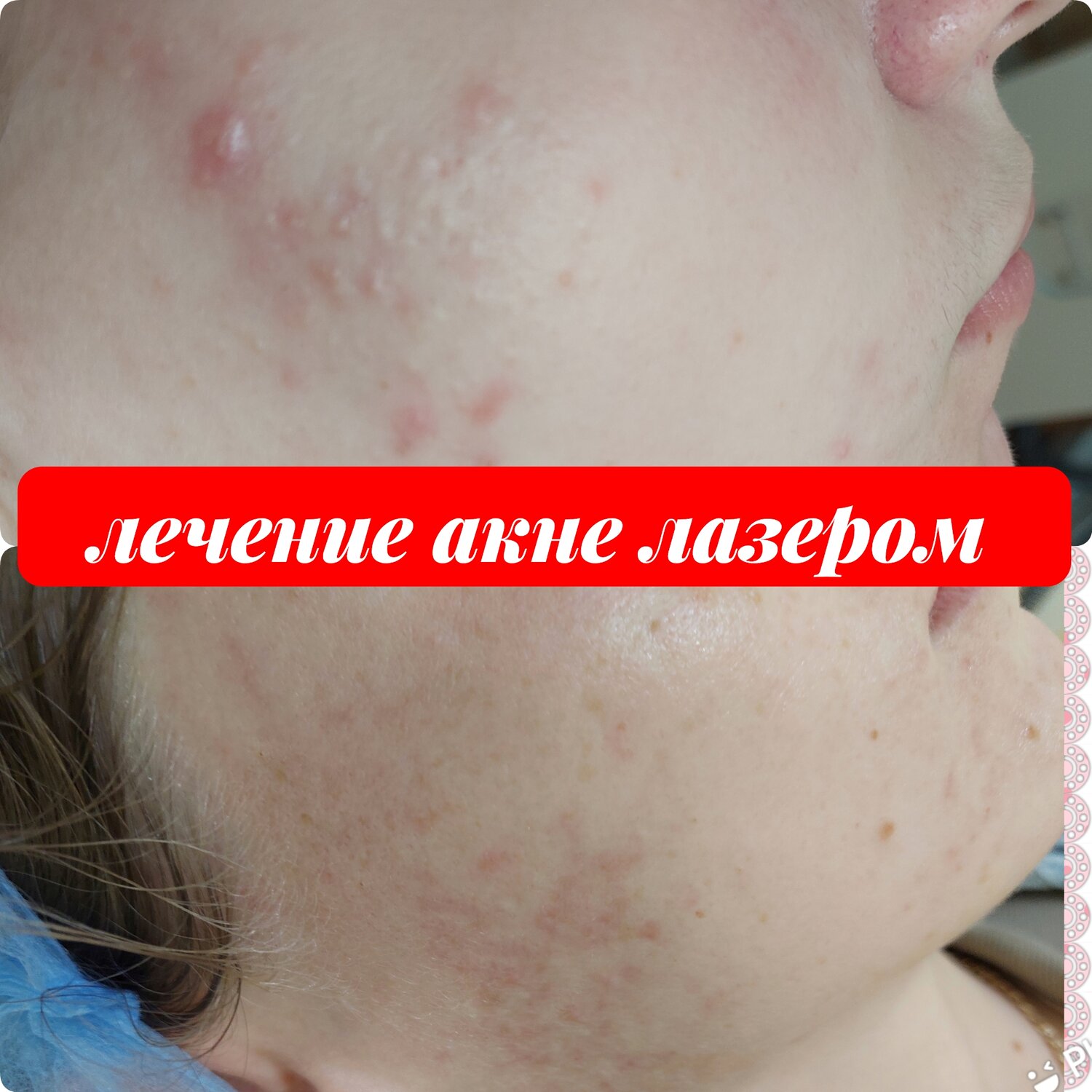 Лечение угревой сыпи