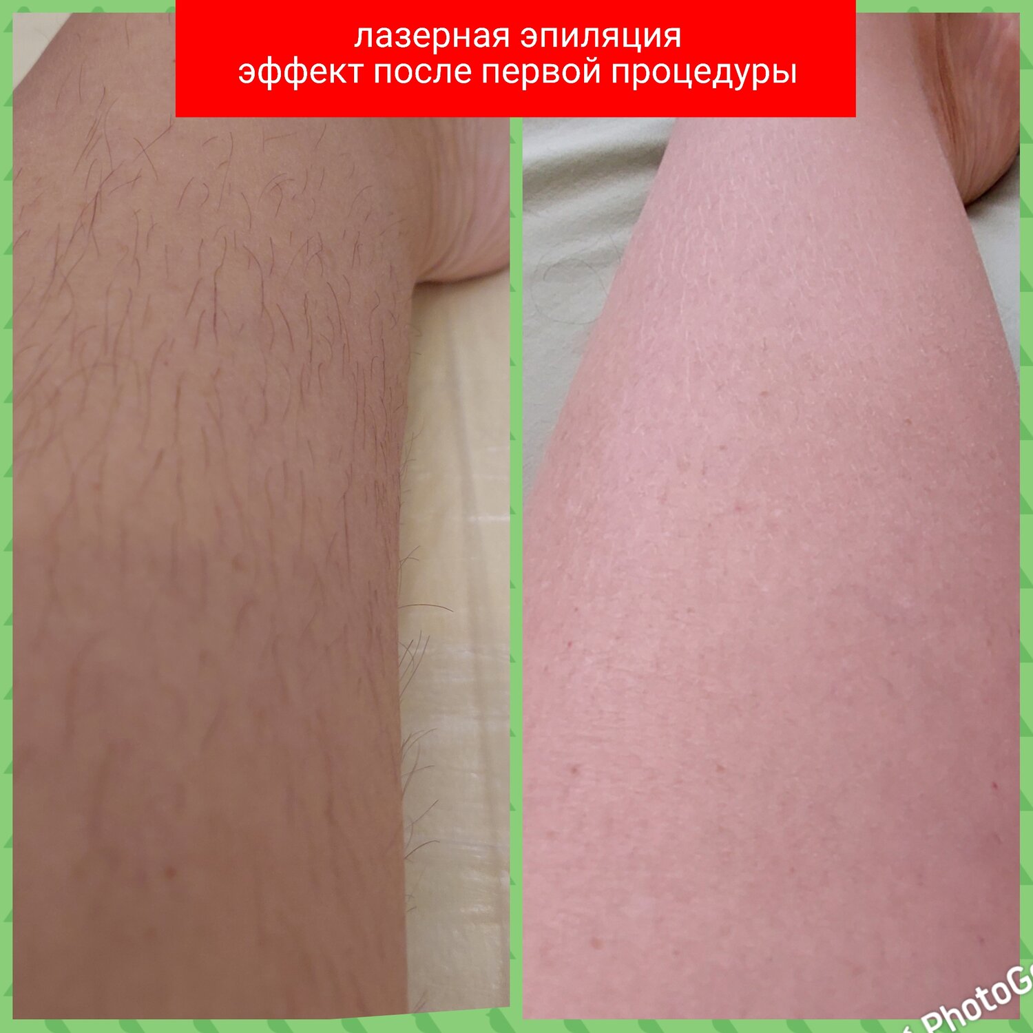 Электроэпиляция: голени