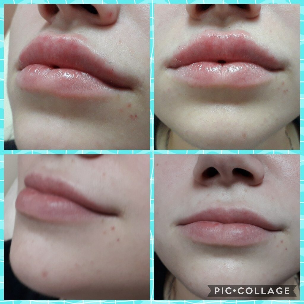 Увеличение губ