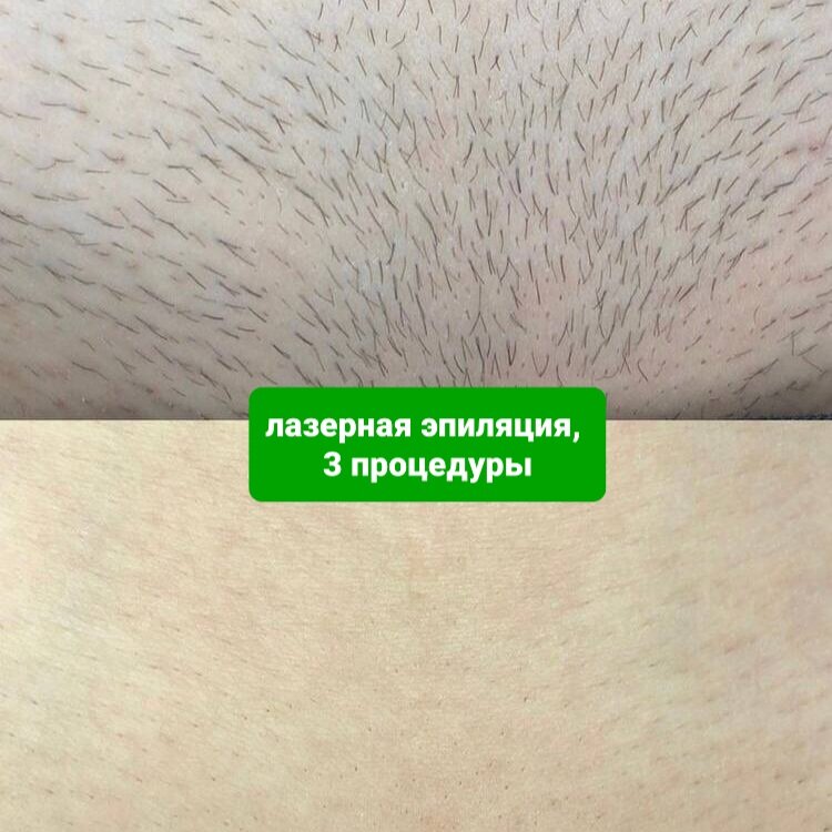 Лазерная эпиляция: глубокое бикини