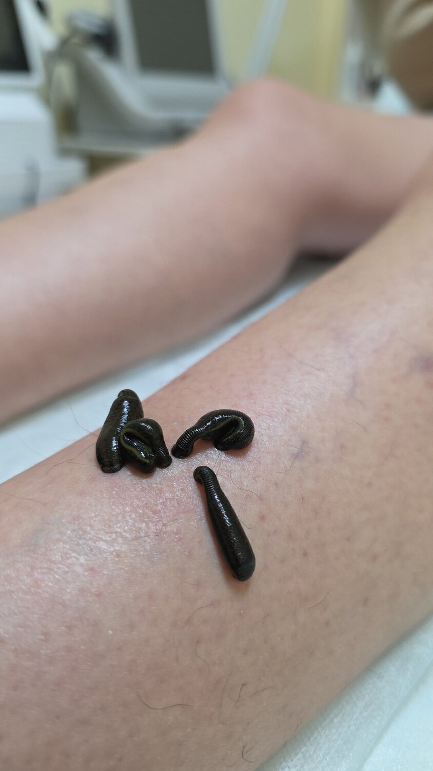 Оздоровление пиявками