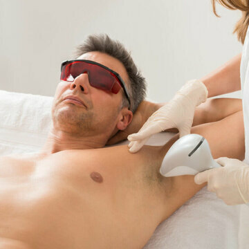 Лазерная эпиляция мужчинам