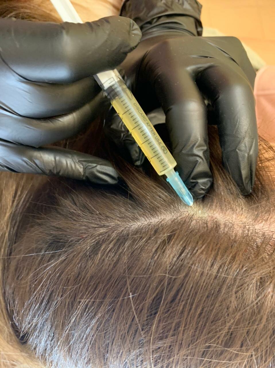 Биоревитализация волос