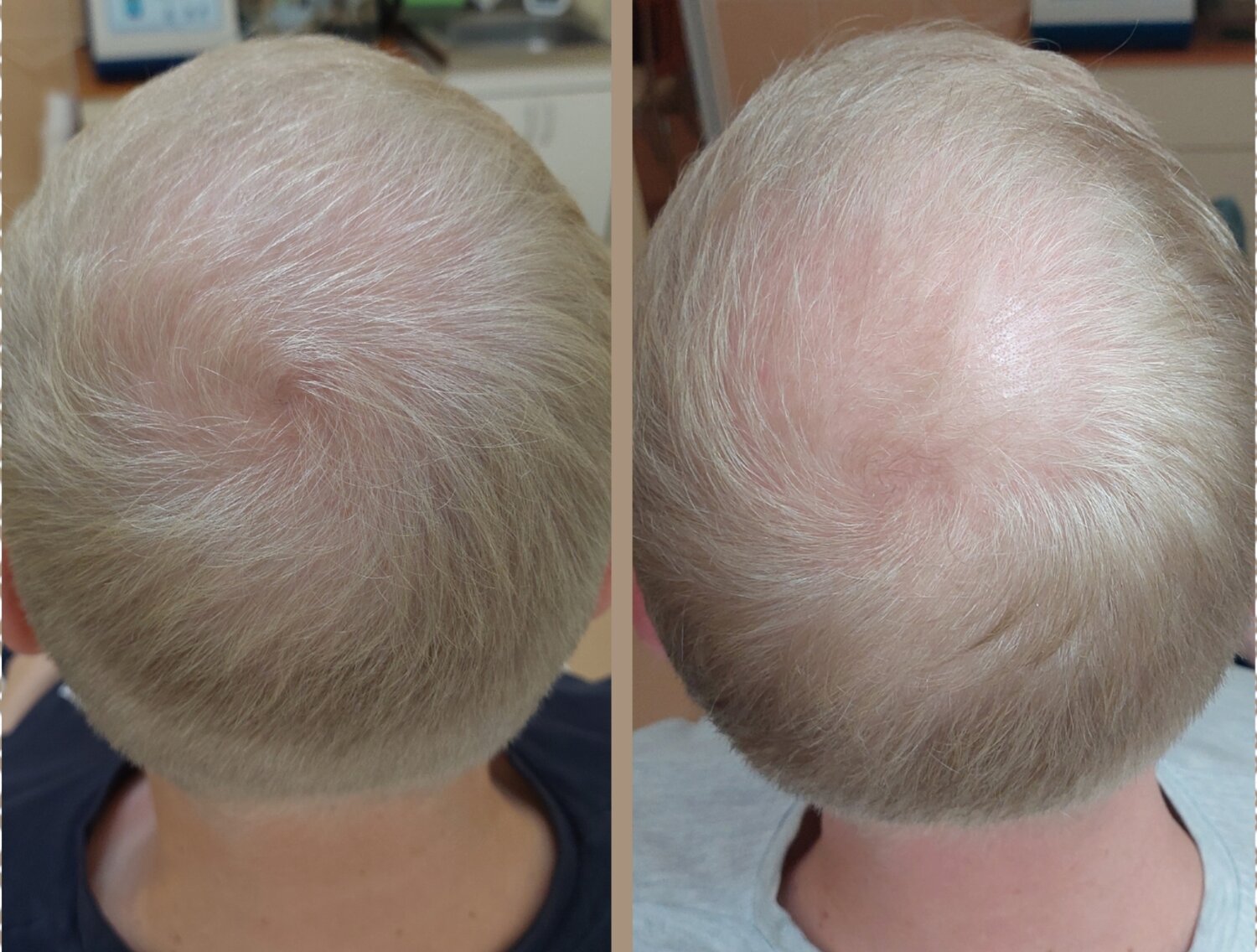 Карбокситерапия