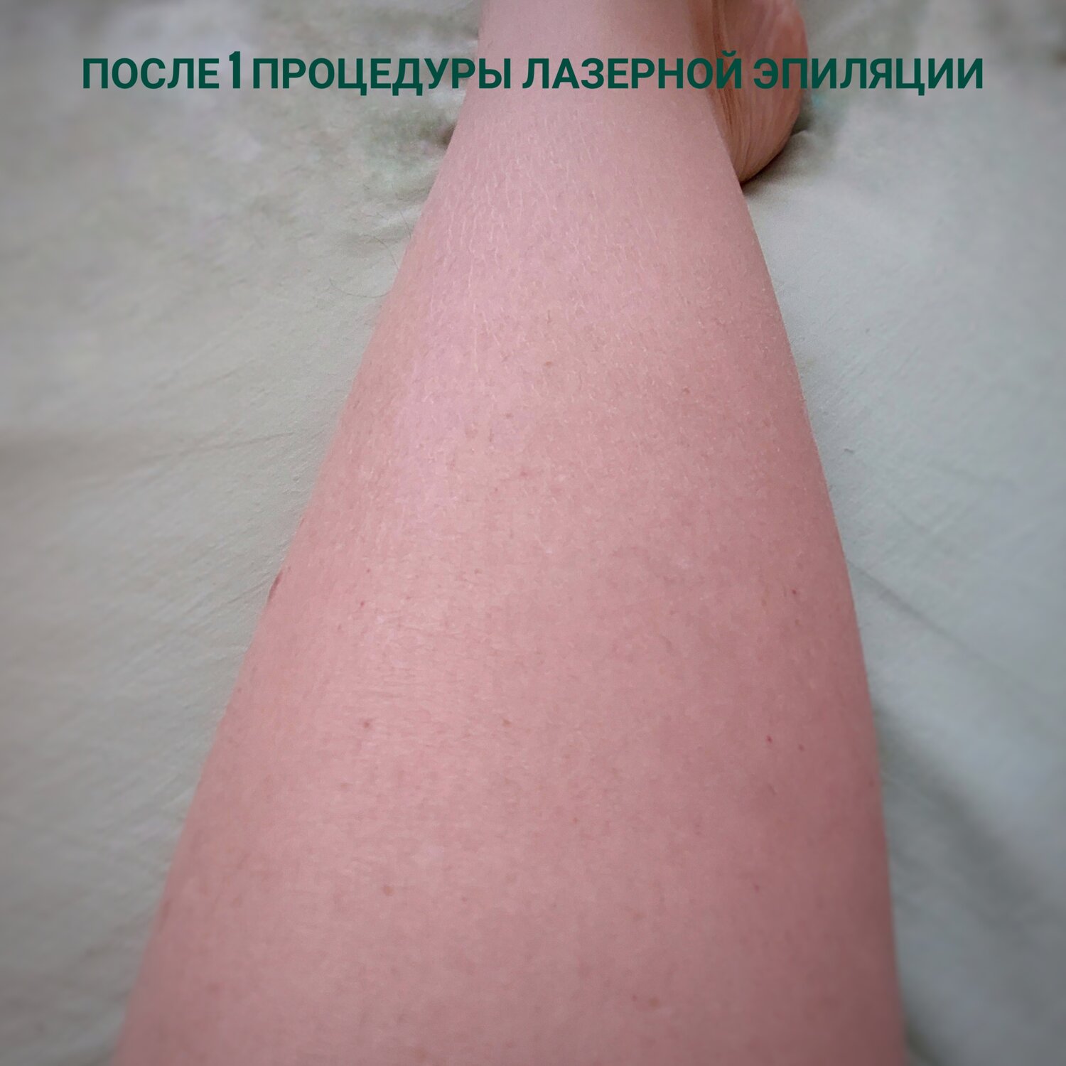 Лазерная эпиляция ног